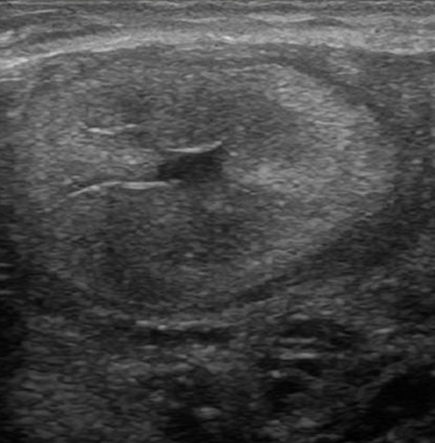 Ultraschallbild eines Gebärmutterhorns im Querschnitt mit eitrigem Schleim